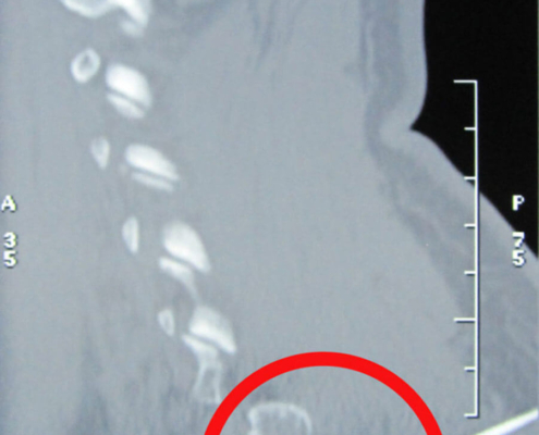 Ernia discale toracica D1-D2: Neuronavigazione TC sagittale pre-operatoria. (L'ago indica l'articolazione costo-trasversaria)